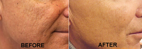 Clearer Skin Ahead: Acne Treatment in Edmonton post thumbnail image